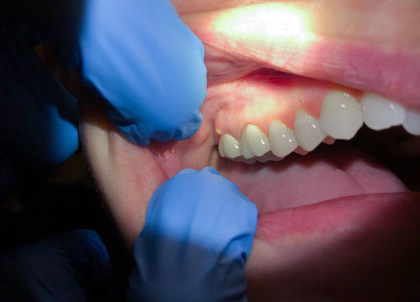 Best Emergency Gum Treatment in Carnegie, PA